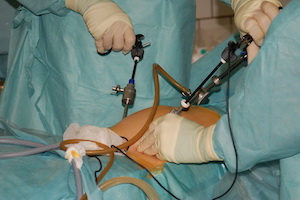 Лечение апоплексии яичника при помощи эндоскопической операции