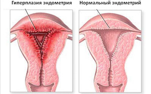 Механизм развития типической гиперплазии эндометрия