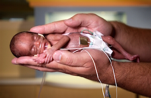 Рождение недоношенного ребенка на сроке беременности 23 недели