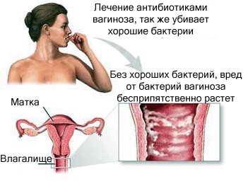 Бактериальный вагиноз - причины и механизм развития