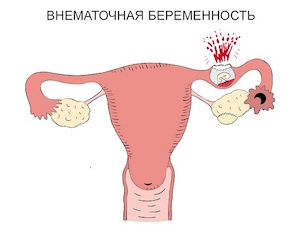 Механизм развития внематочной беременности