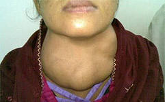 Симптомы базедовой болезни - увеличение щитовидной железы