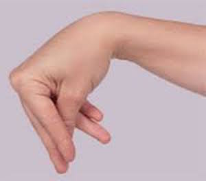 Тонические судороги мышц руки при гипопаратиреозе