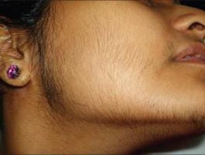 Синдром Штейна-Левентая - появление волос на лице