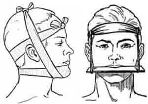 Иммобилизация нижней и верхней челюсти при травме головы
