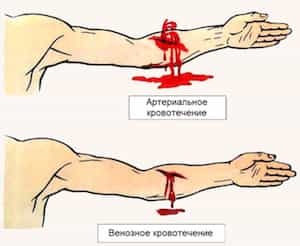 Основные виды кровотечений - артериальное и венозное