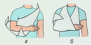 Иммобилизация при вывихе плечевого сустава