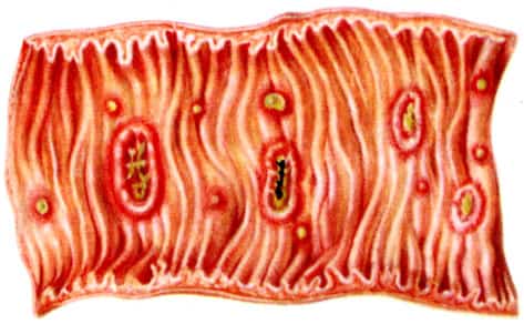 При амебиазе кишечника образуются язвы