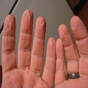 "Руки прачки" - симптом обезвоживания при холере
