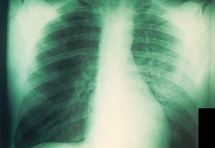 Рентгенограмма при легочной форме чумы