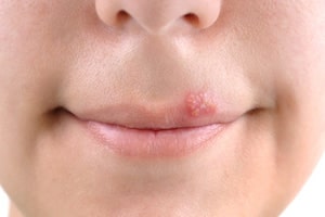 Простуда на губе - это герметическая инфекция