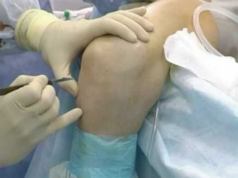 Артроскопия - современный метод исследования суставов