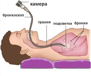 Принцип методики бронхоскопии