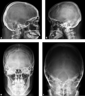 Снимки черепа в разных проекция, полученные при карниографии