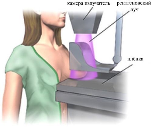 Принцип методики рентгенологической маммографии