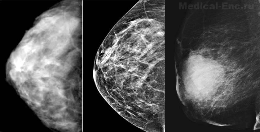 Расшифровка результатов маммографии
