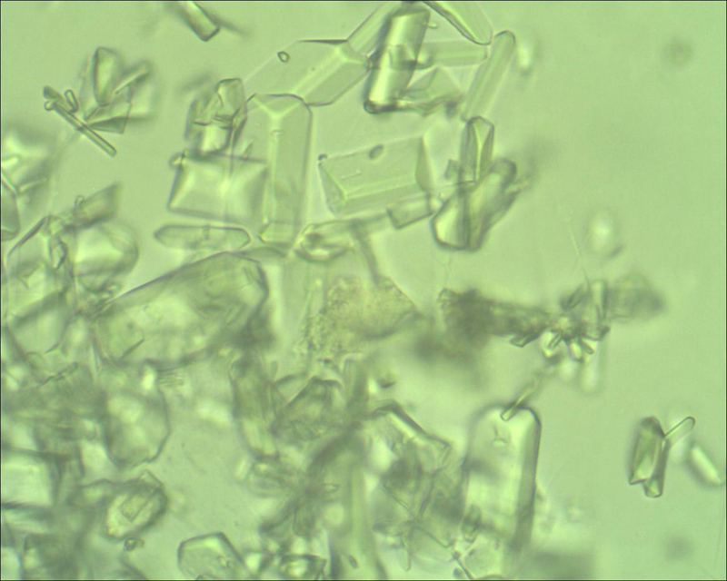 Клинический анализ мочи - кристаллы солей в осадке