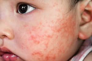 При токсико-аллергическом дерматите у ребенка появляются изменения на коже