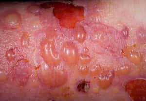 Баллы при развитии токсико-аллергического дерматита у ребенка