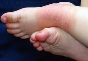 Папулы при токсико-аллергическом дерматите у ребенка