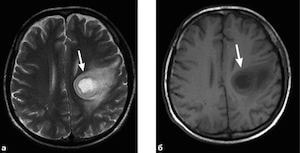 Диагностика абсцесса головного мозга при помощи томографии