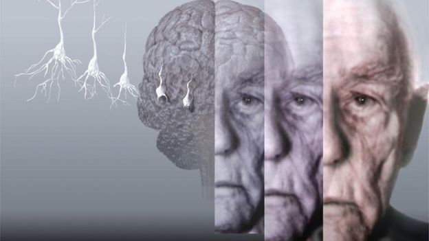 Болезнь Альцгеймера - альтернативный механизм