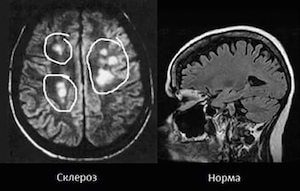 Диагностика рассеянного склероза при помощи МРТ