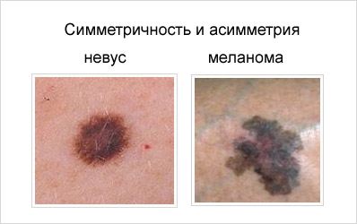 Асимметрия меланомы кожи