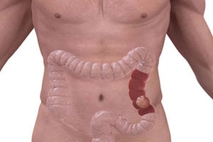 Опухоли кишечника чаще локализуются в толстой кишке