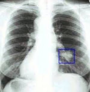 Рентгенологическая диагностика рака легких