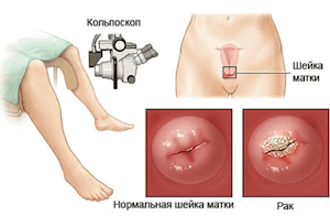 Диагностика рака шейки матки при помощи кольпоскопия