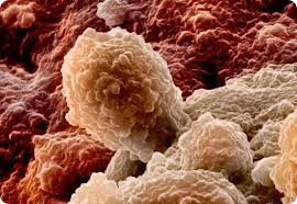 Причины и виды рака простаты - раковая клетка