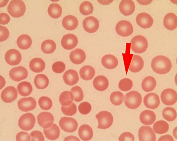 Микросфероциты при микроскопии мазка крови