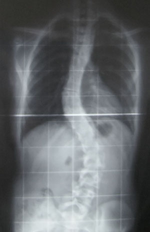 Рентгенологическая диагностика сколиоза у детей