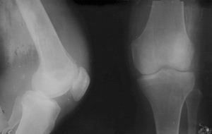 Диагностика ювелирного ревматоидного артрита