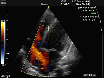 Для диагностики врожденных пороков сердца применяется эхокардиоскопия