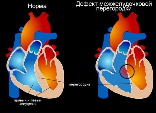 Дефект межжелудочковой перегородки - частый врожденный порок сердца