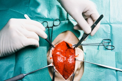 Операция на сердце - основной метод лечения ВПС