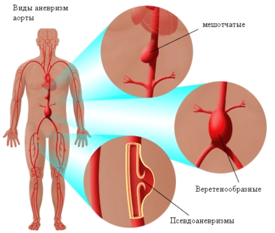 Морфологические виды аневризмы аорты