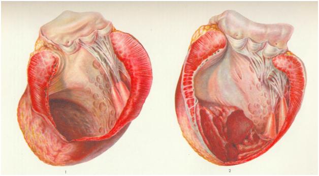Механизм развития аневризмы сердца