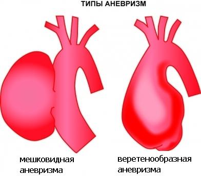 Морфологические виды аневризмы сердца