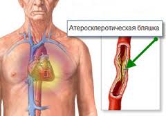Атеросклероз - основная причина стенокардии
