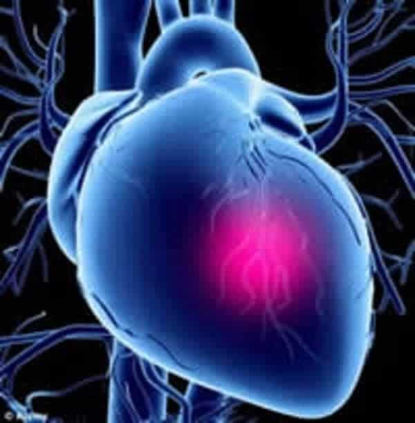 Кардиогенный шок развивается после инфаркта миокарда