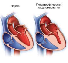 Симптомы гипертрофической кардиомиопатии