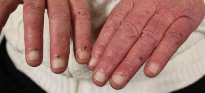 Признаки инфекционного эндокардита на пальцах