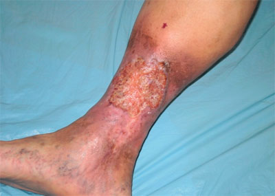 Трофическая язва при облитерирующем атеросклерозе ног