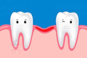 Альвеолит - воспаление тканей лунки после удаления зуба