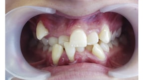 Аномалия положения зубов