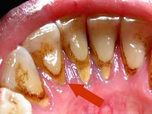 Зубной камень - причина развития строфического гингивита