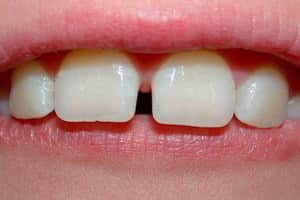 Диастема - щель между зубами